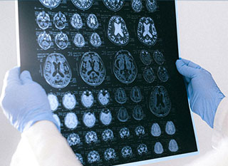 brain trauma